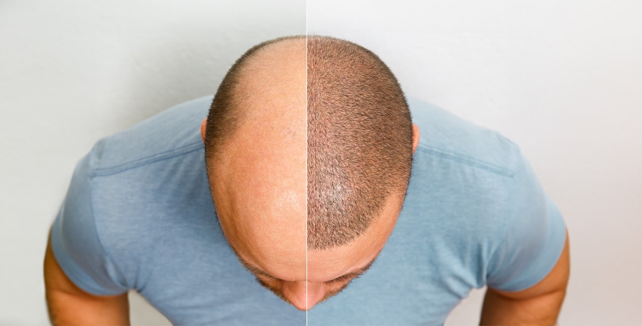 hair transplant shock loss 2026